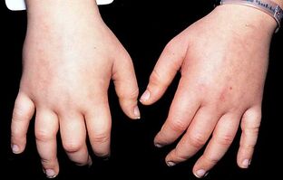 Edema