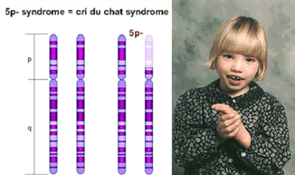 what causes cri du chat